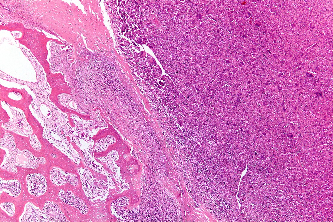 File:Osteosarcoma - low mag.jpg