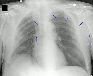 Peripherally inserted central catheter Catheter intended for long periods of use