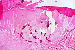 Perforeren van osteoma cutis, huid van de voet (14174858691) .jpg