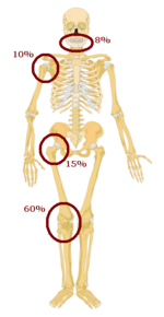 Favoured sites for the development of an osteosarcoma. Predilection sites of osteosarcoma2.png