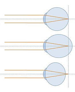 <span class="mw-page-title-main">Refractive error</span> Problem with focusing light accurately on the retina due to the shape of the eye