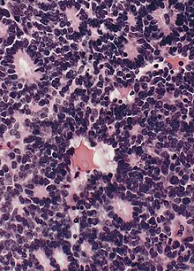 Flexner-Wintersteiner rosettes in Retinoblastoma. Retinoblastoma rosette.jpg