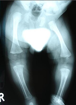 <span class="mw-page-title-main">Congenital distal spinal muscular atrophy</span> Hereditary condition characterized by muscle wasting