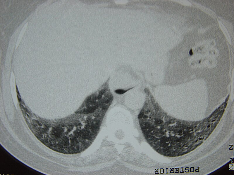 File:Systemic sclerosis case 06 pic 13.jpg