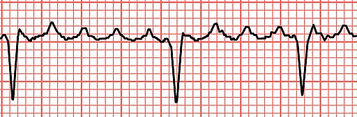 Atrial Flutter Unlabeled