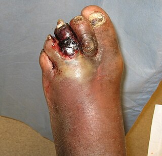 <span class="mw-page-title-main">Diabetic foot infection</span> Medical condition