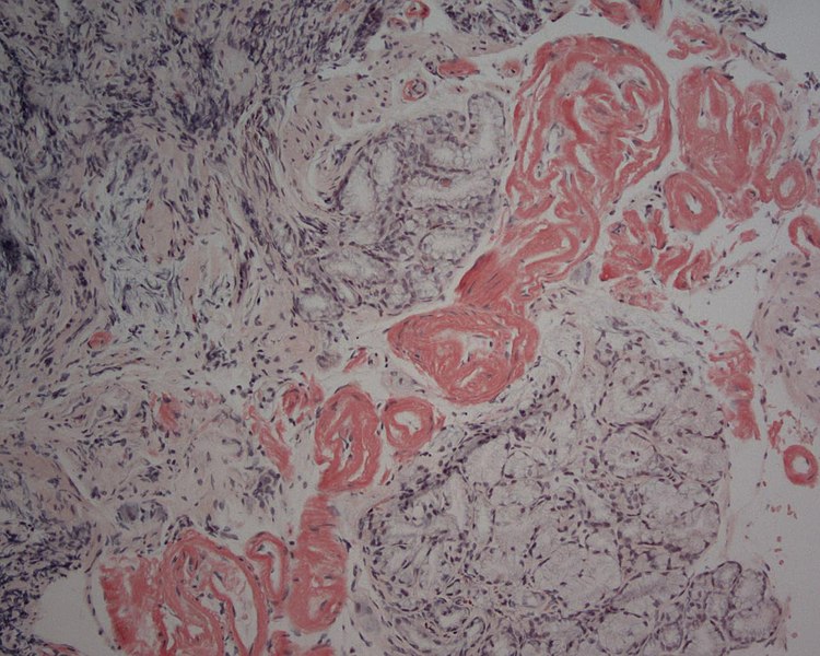 File:Duodenum Amyloid 20x1 CRlight.jpg