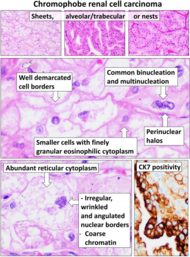 Histopathology of chromophobe renal cell carcinoma.png