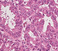 Histopatología de la neoplasia mucinosa papilar intraductal pancreatobiliar en el páncreas.jpg