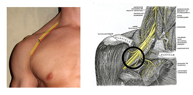 File:Infraclavicular block.jpg