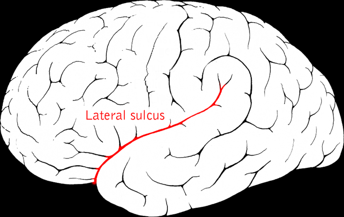 Perisylvian syndrome