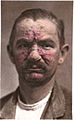 Rosacea