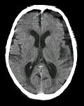 Thumbnail for Subdural hygroma