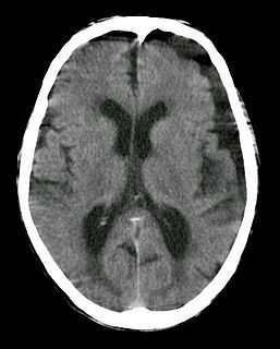 <span class="mw-page-title-main">Subdural hygroma</span> Collection of cerebrospinal fluid (CSF), without blood, located under the dural membrane