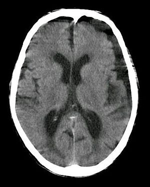 Subdural hygroma, frontal and temporal.jpg