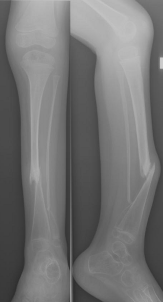 <span class="mw-page-title-main">Congenital pseudarthrosis of the tibia</span>