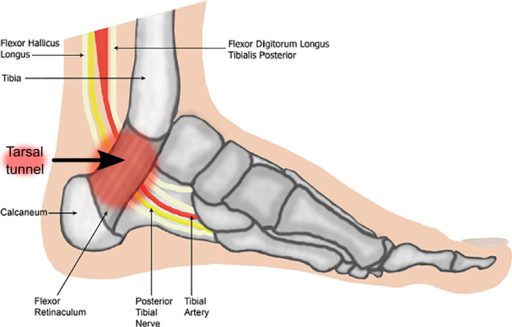 Tarsal tunnel syndrome is one of the causes of numbness in the bottom of the foot