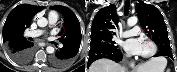 CT scan of the chest showing a thrombus in the left atrial appendage (left: axial plane, right: coronal plane)