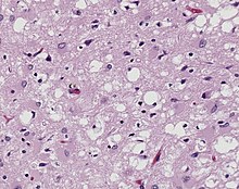 Magnified 100X, and stained with H&E (hematoxylin and eosin) staining technique, this light photomicrograph of brain tissue reveals the presence of prominent spongiotic changes in the cortex, and loss of neurons in a case of variant Creutzfeldt-Jakob disease (vCJD). Variant Creutzfeldt-Jakob disease (vCJD), H&E.jpg