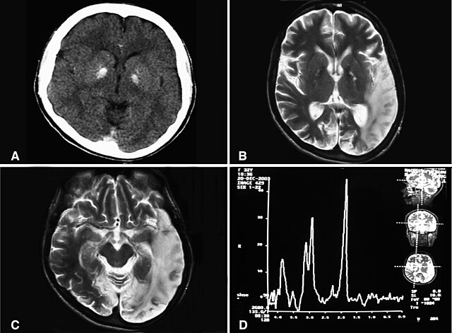 Una tomografía computarizada del cerebro que muestra calcificación de los ganglios basales bilaterales