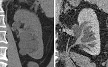 Non-contrast CT (at left) showing peripelvic fluid accumulations, which may be hydronephrosis. CT urography (at right) reveals non-dilated calyces and pelvises. The fluid accumulations are thus peripelvic cysts. CT of peripelvic cysts with non-contrast and urography.jpg