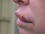 Herpes Simplex