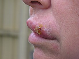 Kéregek a herpes simplex hólyagok helyén az ajkakon