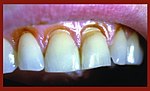 Миниатюра для Файл:Dental abrasion klinovidny de207.jpg