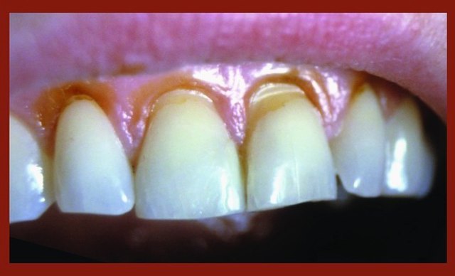 Ослабление зубной эмали