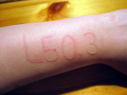 Urticaria dermatológica.jpg