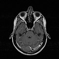 MRI image showing deviated septum