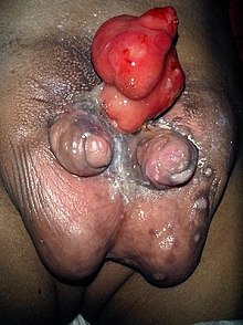 The external male genitalia of a prepubescent male with a form of bifid diphallia with an anomaly around the mons pubis