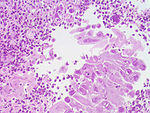 http://upload.wikimedia.org/wikipedia/commons/thumb/4/42/Esophagus_herpes_2.jpg/150px-Esophagus_herpes_2.jpg