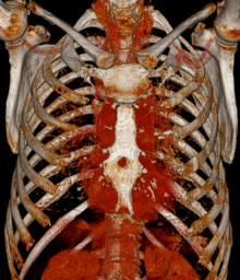 Sternal foramen seen on three-dimensionally constructed CT scan Foramen sternale 57jw - CT VR - 001.png