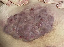 Hidradenitis suppurativa stage III on abdomen: Skin is red and inflamed, constantly draining a malodorous blood/pus mixture. Pain is severe. HS on abdomen.jpg