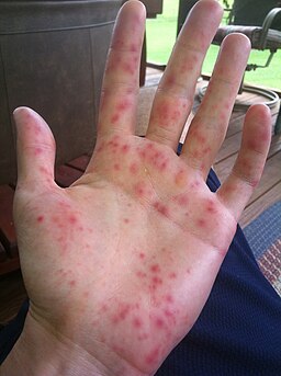 Hand, Foot and Mouth Disease Blisters