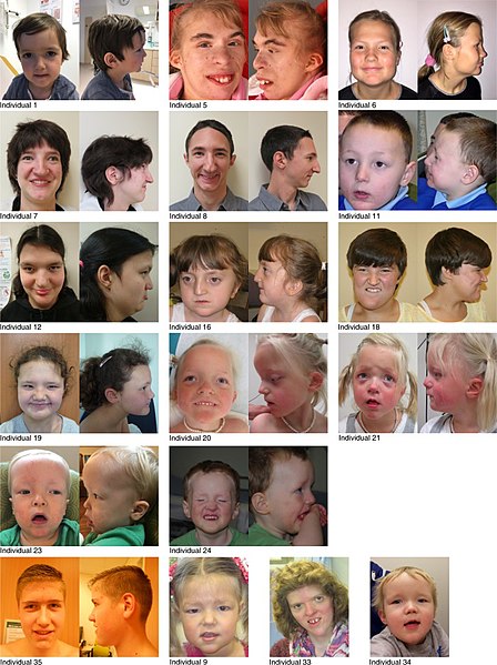 File:Individuals who have Snijders Blok-Campeau syndrome.jpg