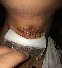 Image of a surgical site infection caused by stitching Infected site.jpg