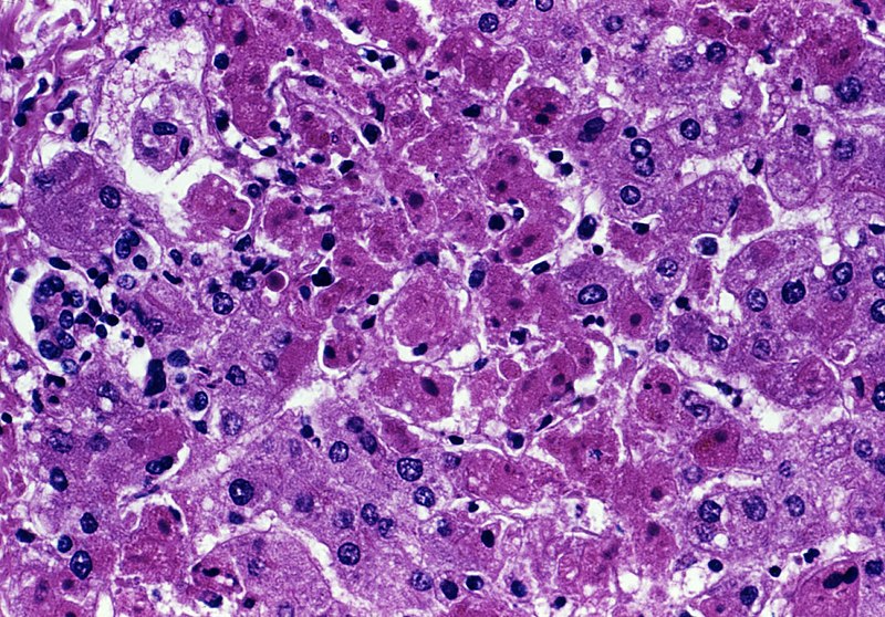 File:Marburg virus liver injury.jpg