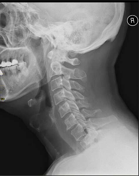 File:Medical X-Ray imaging PJD06 nevit.jpg