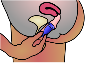 330px-Menstrual_cup_insertion.svg.png