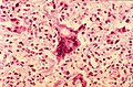 Ιστοπαθολογία ιλαράς με γιγαντοκυτταρική πνευμονία