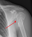 Fracture of the proximal humerus with involvement of the greater tubercle