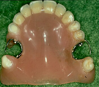 Removable partial acrylic resin denture 742.jpg