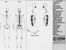 Gammagrafía ósea, donde se encontró una lesión en el borde inferior derecho de la cuenca del ojo.