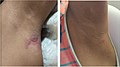Yaws papillomas on axilla significantly reduced in size 2 weeks and completely resolved 3-and-a-half months after one-dose azithromycin was taken.jpg
