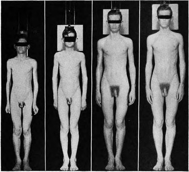 File:Boy through puberty 11.3yo (prepuberal) 12.5yo, 14.9yo and 16.3yo (post puberal).jpg