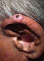 Chondrodermatitis – Ohrknötchen am Helix