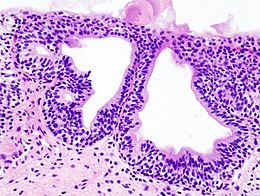 Cystitis glandularis at trigone.jpg