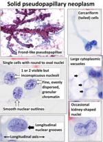 Thumbnail for Solid pseudopapillary tumour